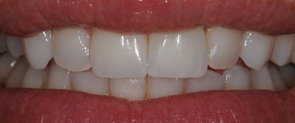 Case-crowns-1-after-960x400